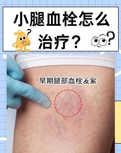 血栓形成前或刚形成时，身体会发“警报”，早发现能避免心梗、中风这些严重问题，大家