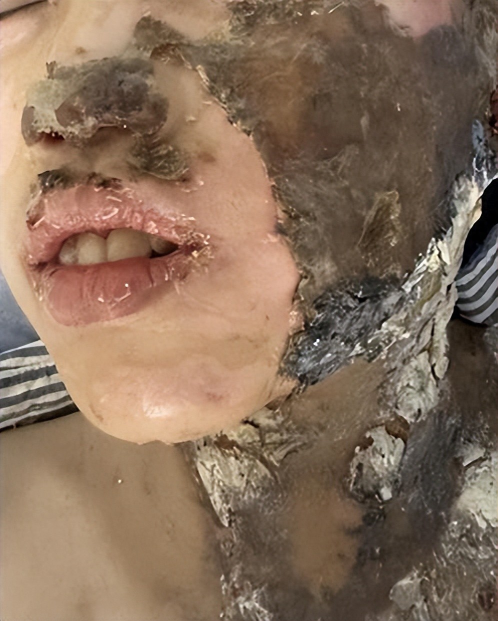 温州一小学生实验课上被深度烧伤，预估数百万元治疗费谁负责？校