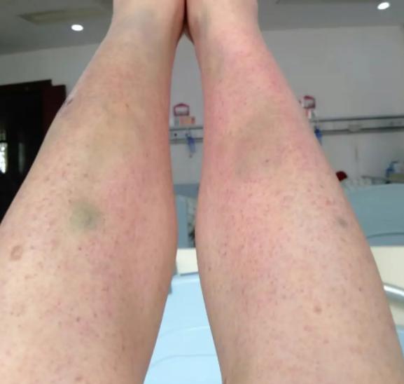 皮肤很容易淤青怎么回事

皮肤容易淤青可能由毛细血管脆弱、维生素缺乏、凝血功能障