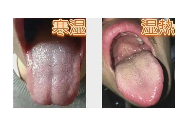 中医教你看舌苔，辨健康！ 1、舌边有齿痕——脾虚湿重 （湿气重容易胖部位是腹部）