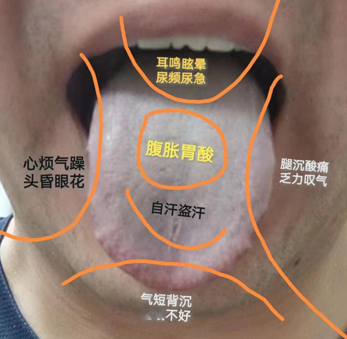 凡是这种舌象，像似缺血，实则阳亏！
血虚不可怕，阳虚也不可怕，就怕你分不清，调理