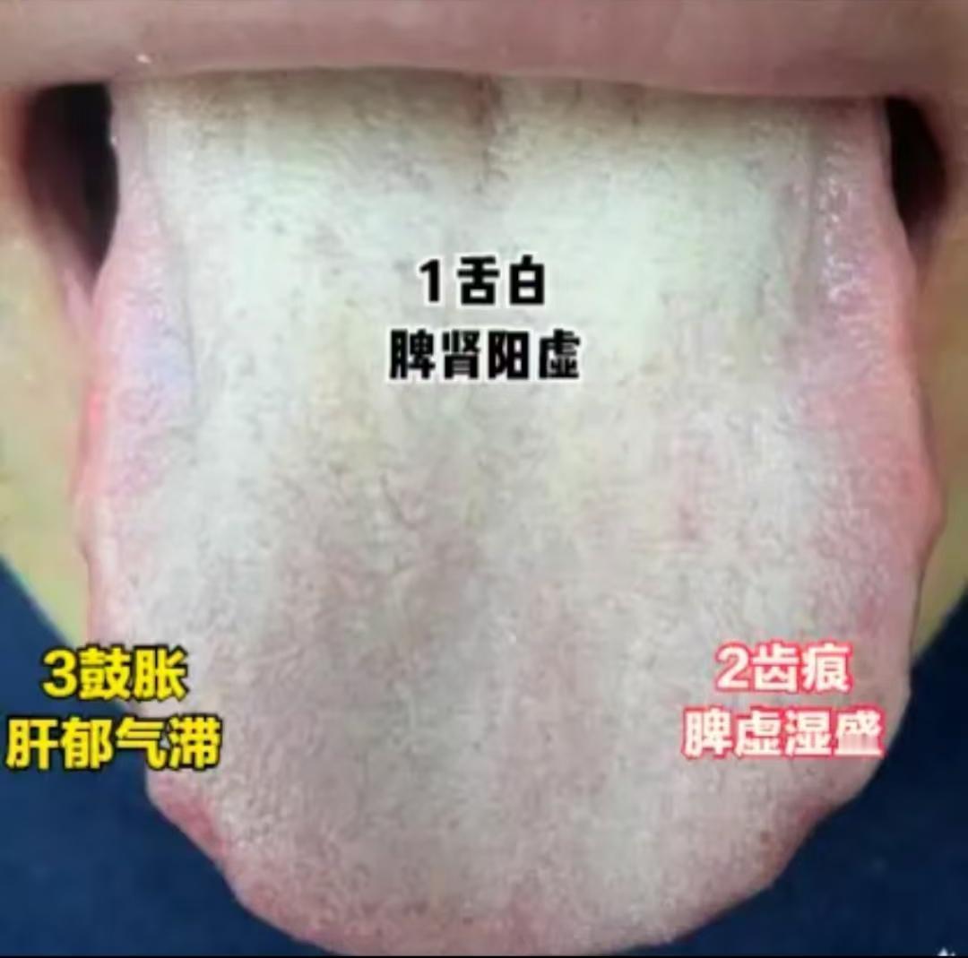 男人害怕的舌象，一白二痕三鼓胀！这位患者的舌头全占了，来看看是怎么回事？

一白