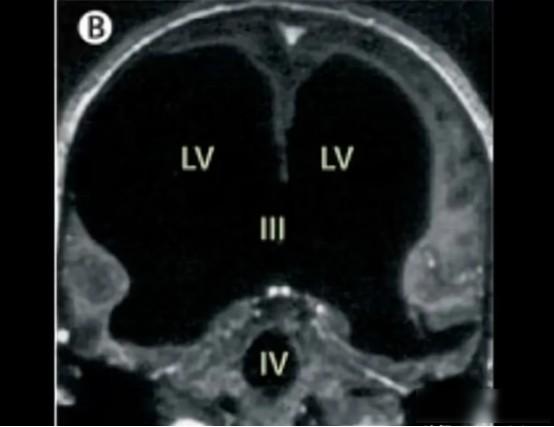 2007年，法国出现了一个“无脑”人！原来一男子在做脑部检查时，竟然被发现他没有