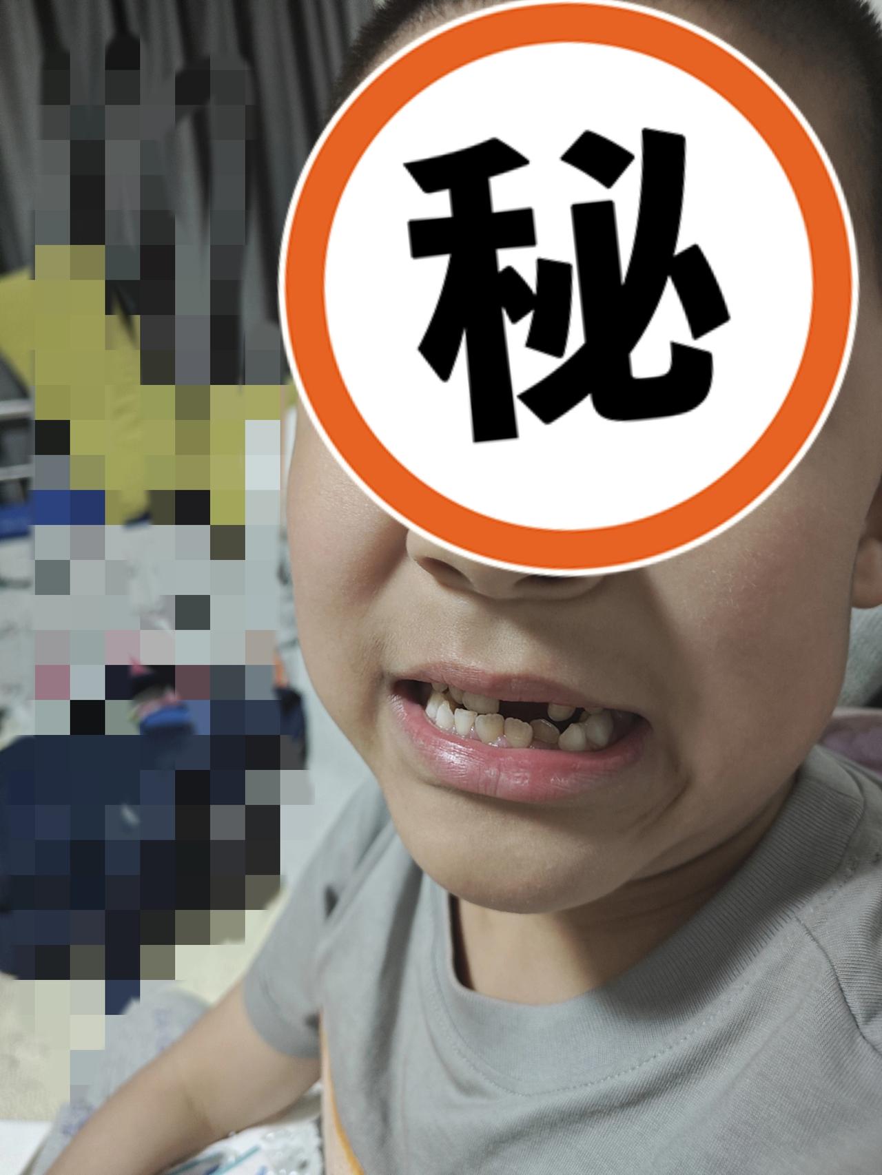 孩子掉牙咋变难了？
小儿从去年开始换牙，
神奇的是，
外面的牙齿还没掉，
新牙已