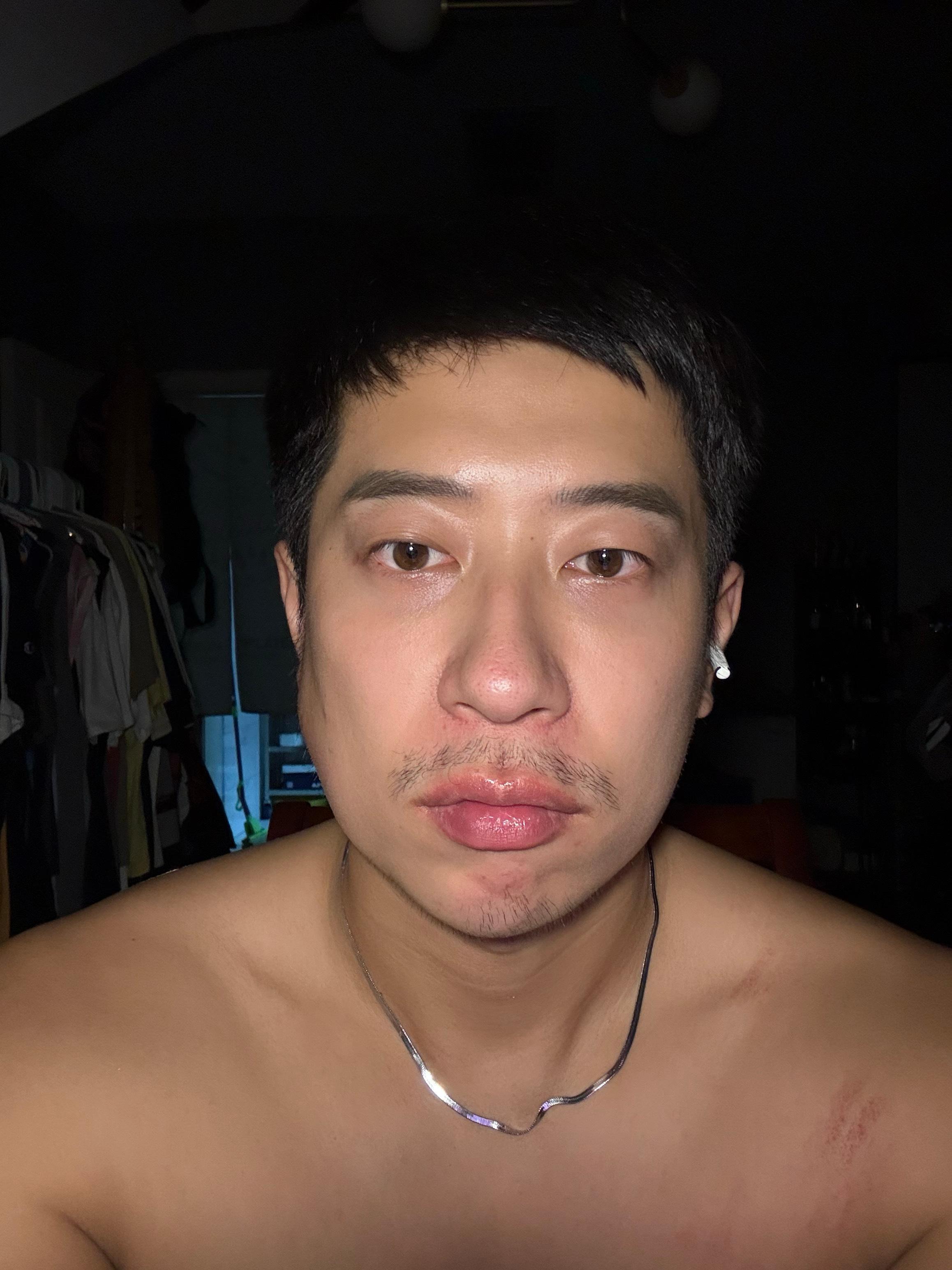 淋巴肿成大窝瓜了 ​​​