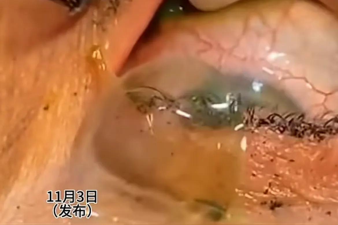女子常忘取隐形眼镜，一个月后医生从其右眼取出23枚镜片。网友:这女子实在少见，都