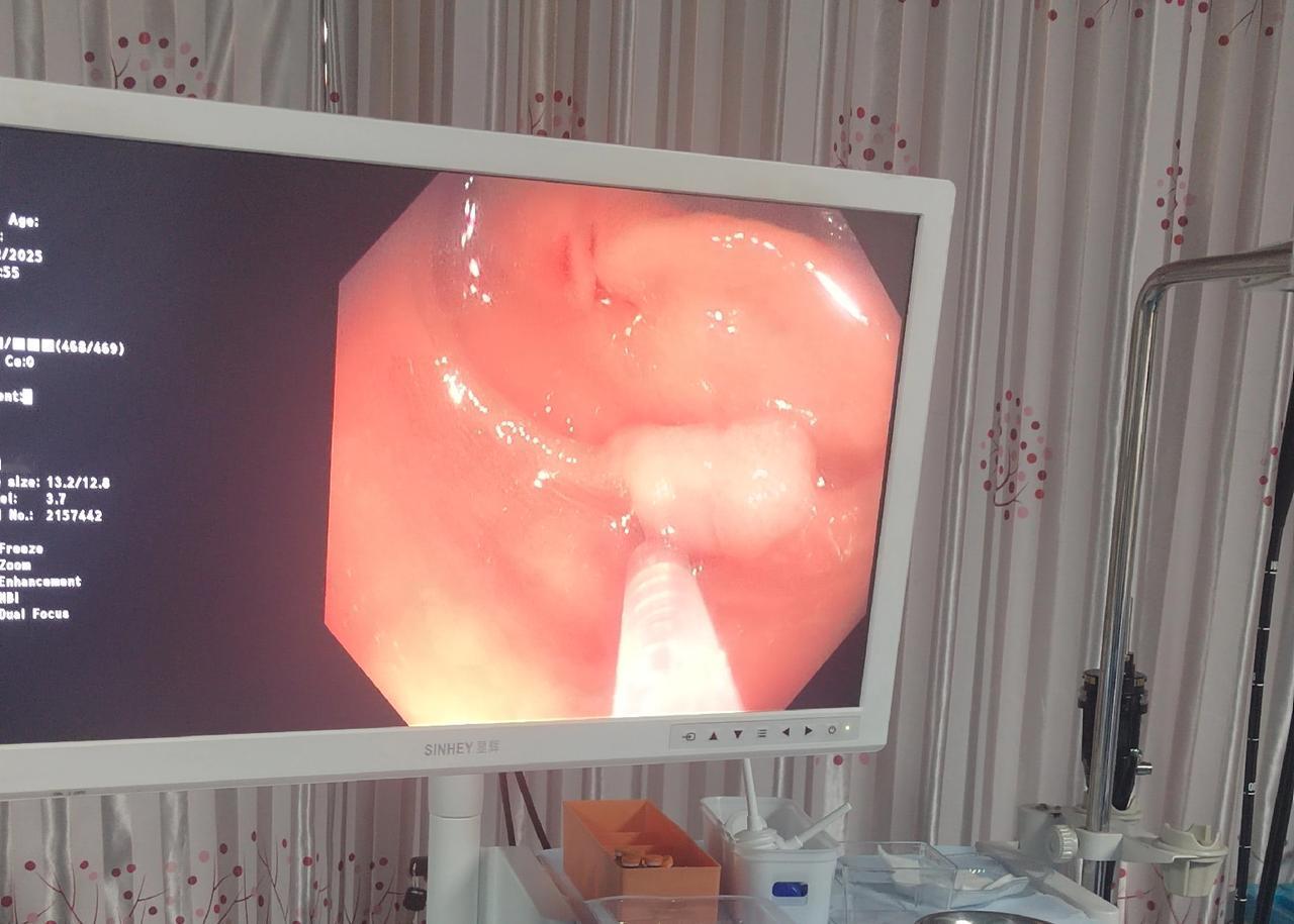 5年前肠子里没有息肉，并不代表它就不长息肉了。

今天一位65岁的大妈在医院里做