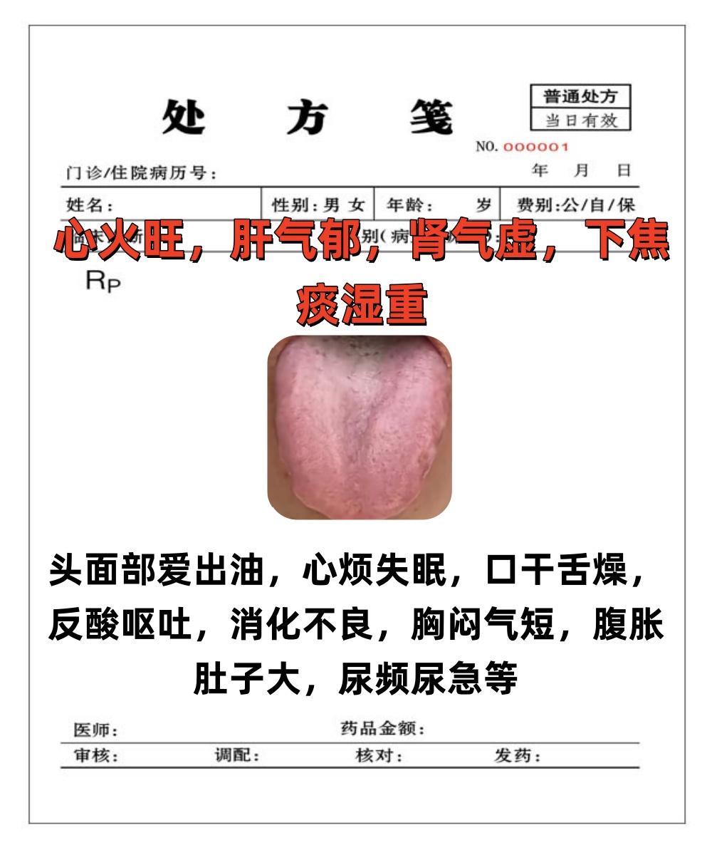 粉丝舌象分析，只要你发我就看，坚持为大家看舌象！

1.心火旺，肝气郁，肾气虚，