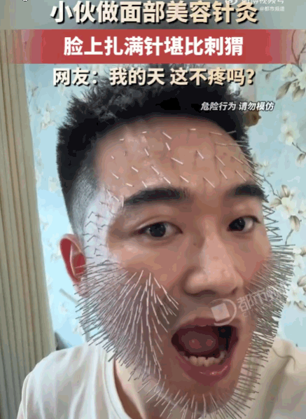 是个狠人！山东，一小伙为了改善面部状态，毅然体验了面部针灸疗法，只见医师手法极快