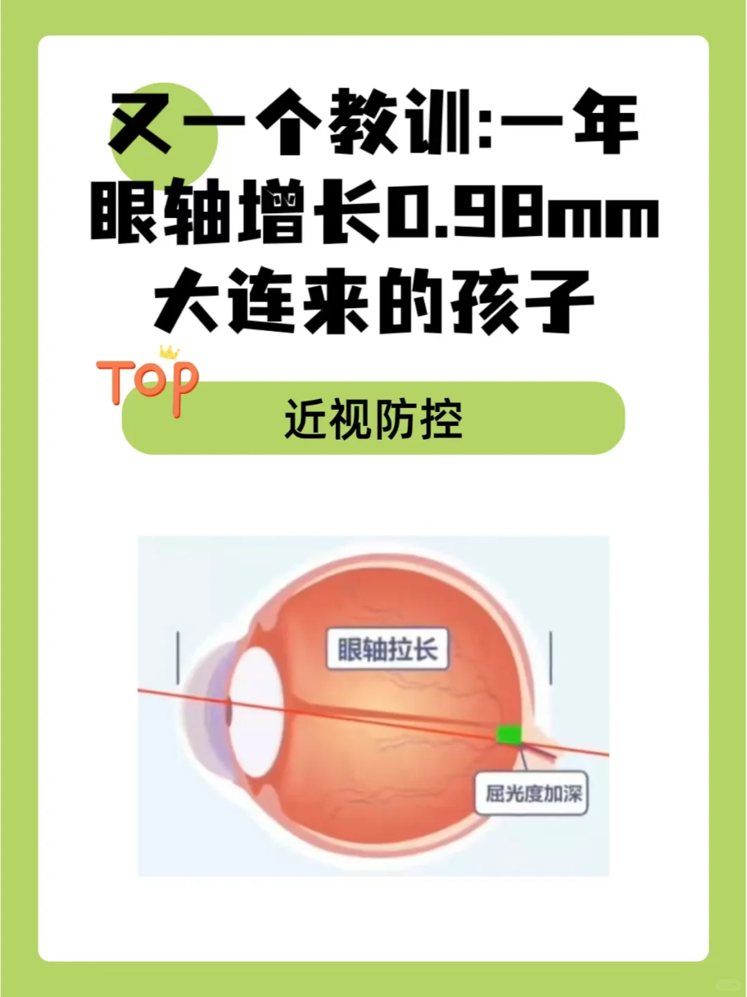 又一个教训:一年眼轴增长0.98mm