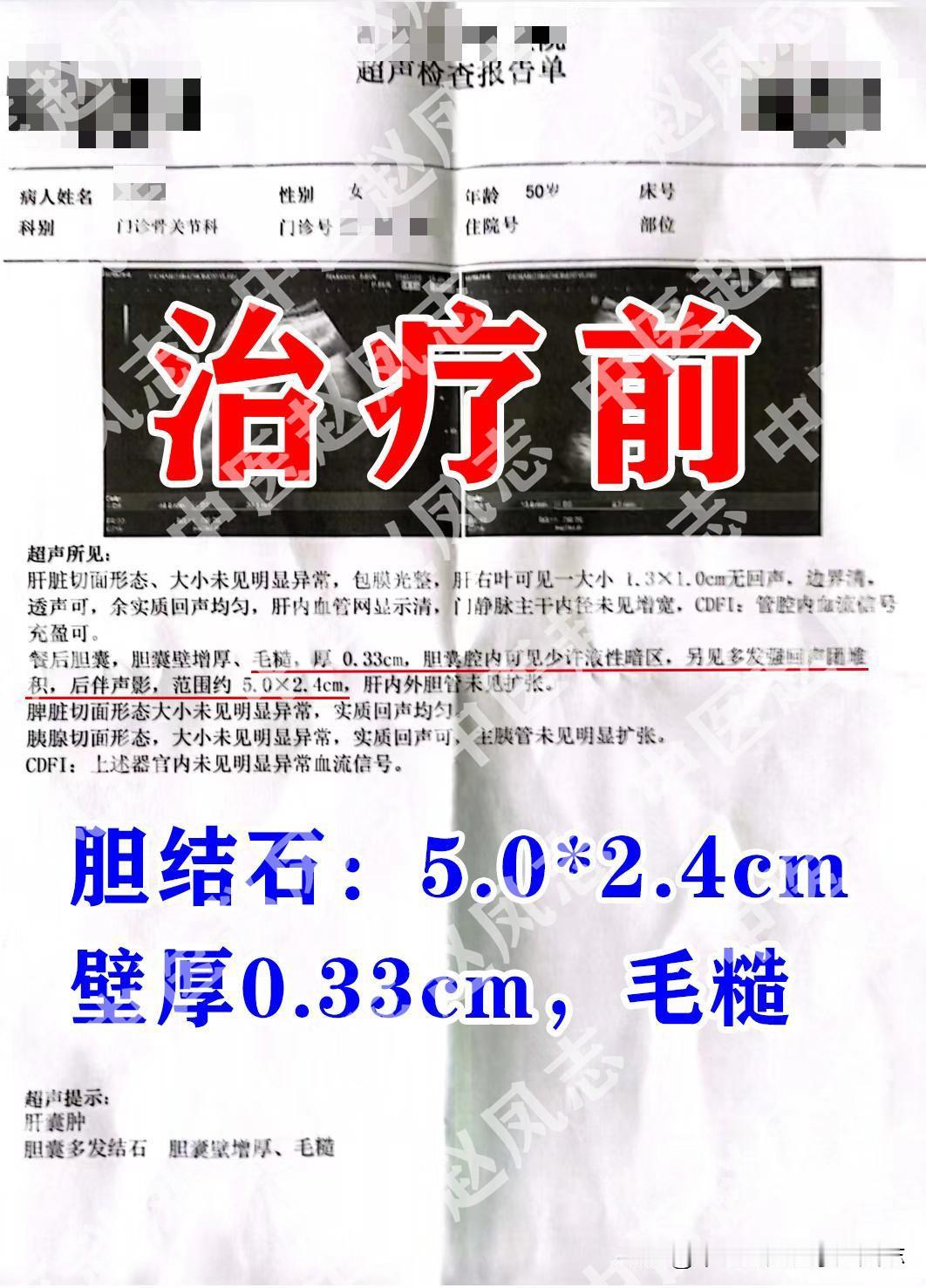 刘女士结石比较大，5.0*2.4cm，胆囊壁增厚约0.33cm，毛糙，已经预约手