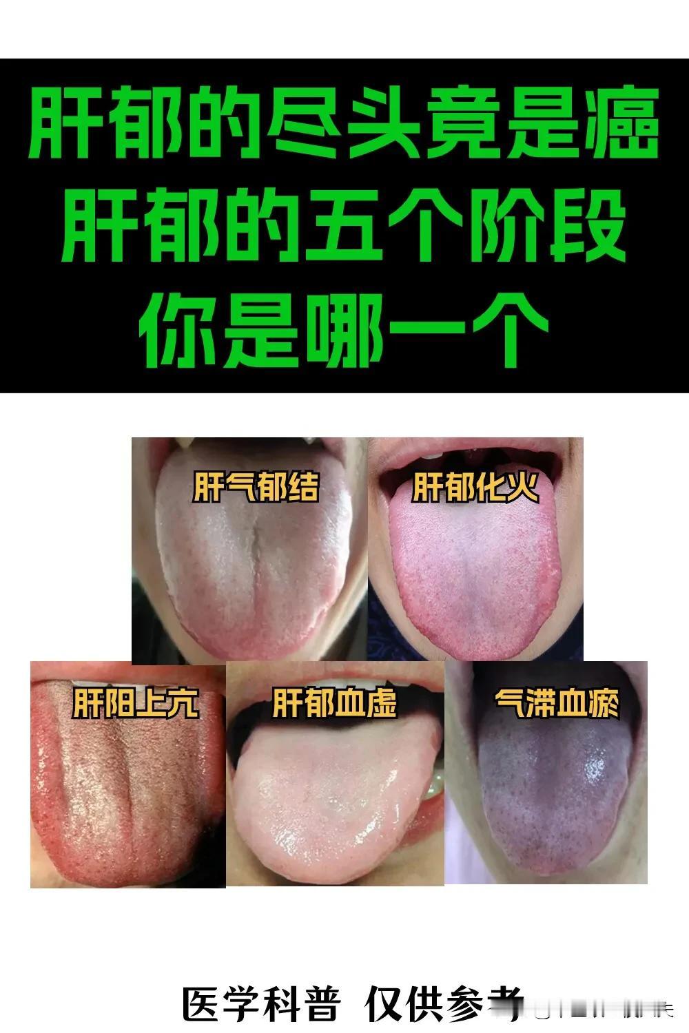 肝郁五个阶段，看看你是哪一个#健康养生# #舌诊# #肝#