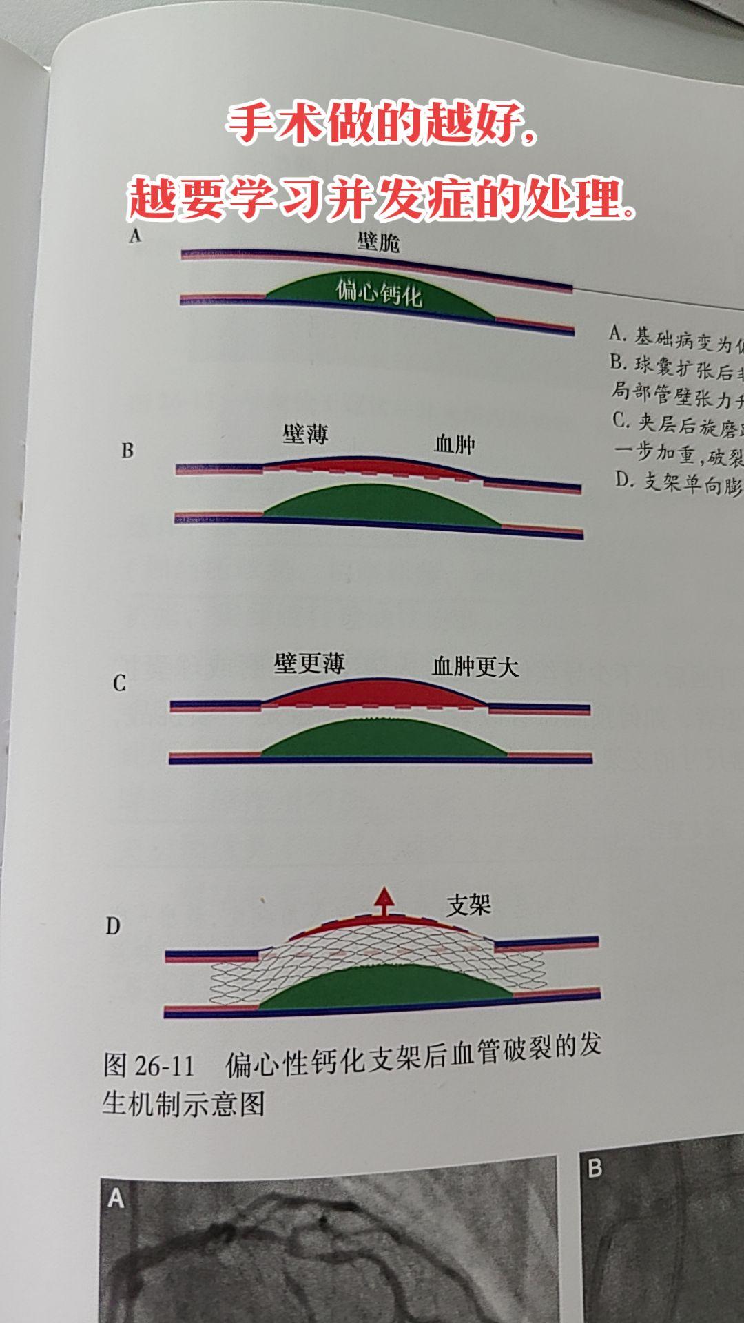 深入了解血管破裂的发生机制，避免并发症。
