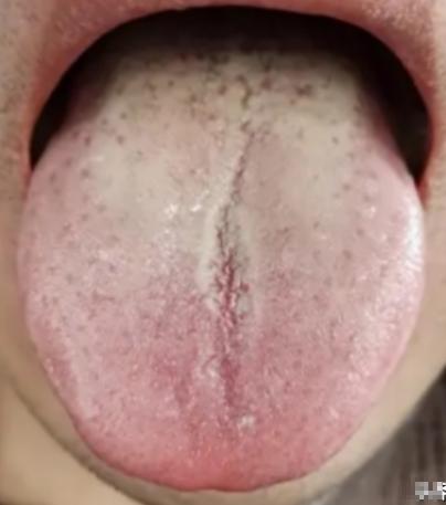 男科不及格的人，一看舌头就知道了！

我们来看这位患者的舌头，一眼看上去好似病在