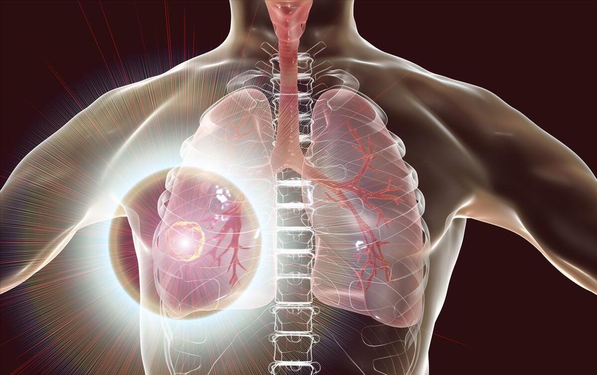 CT、PETCT都显示是肺癌，结果手术证实良性，家属很开心
病床上一个老年患者，