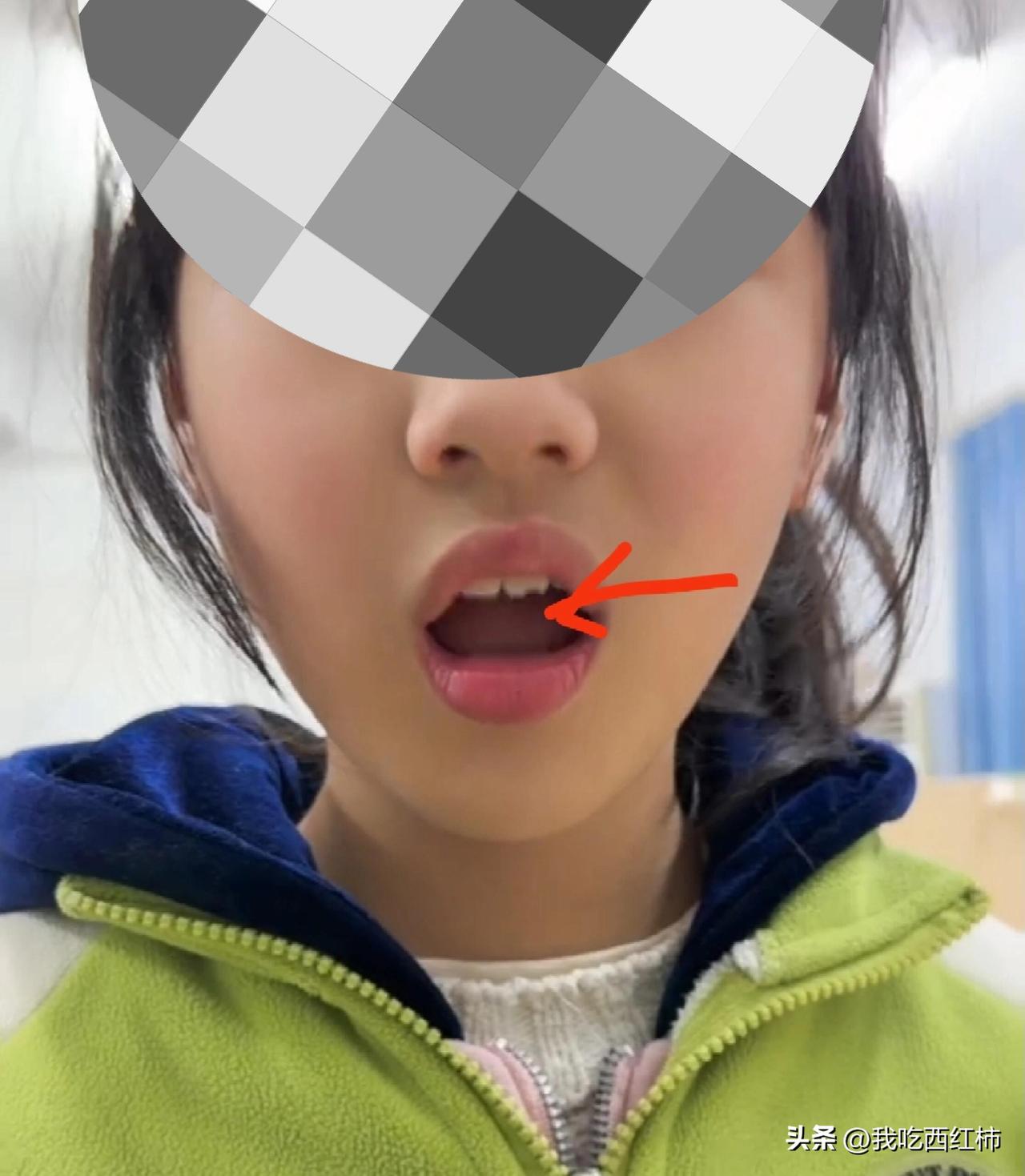 孩子在学校被同学推倒，对方全责。磕掉一颗门牙四分之一，前面还好，背后伤得多，万幸