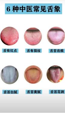 整理了中医常见的6种舌象，看看你是哪一种？
 
1、舌有红点

2、舌有裂纹
 