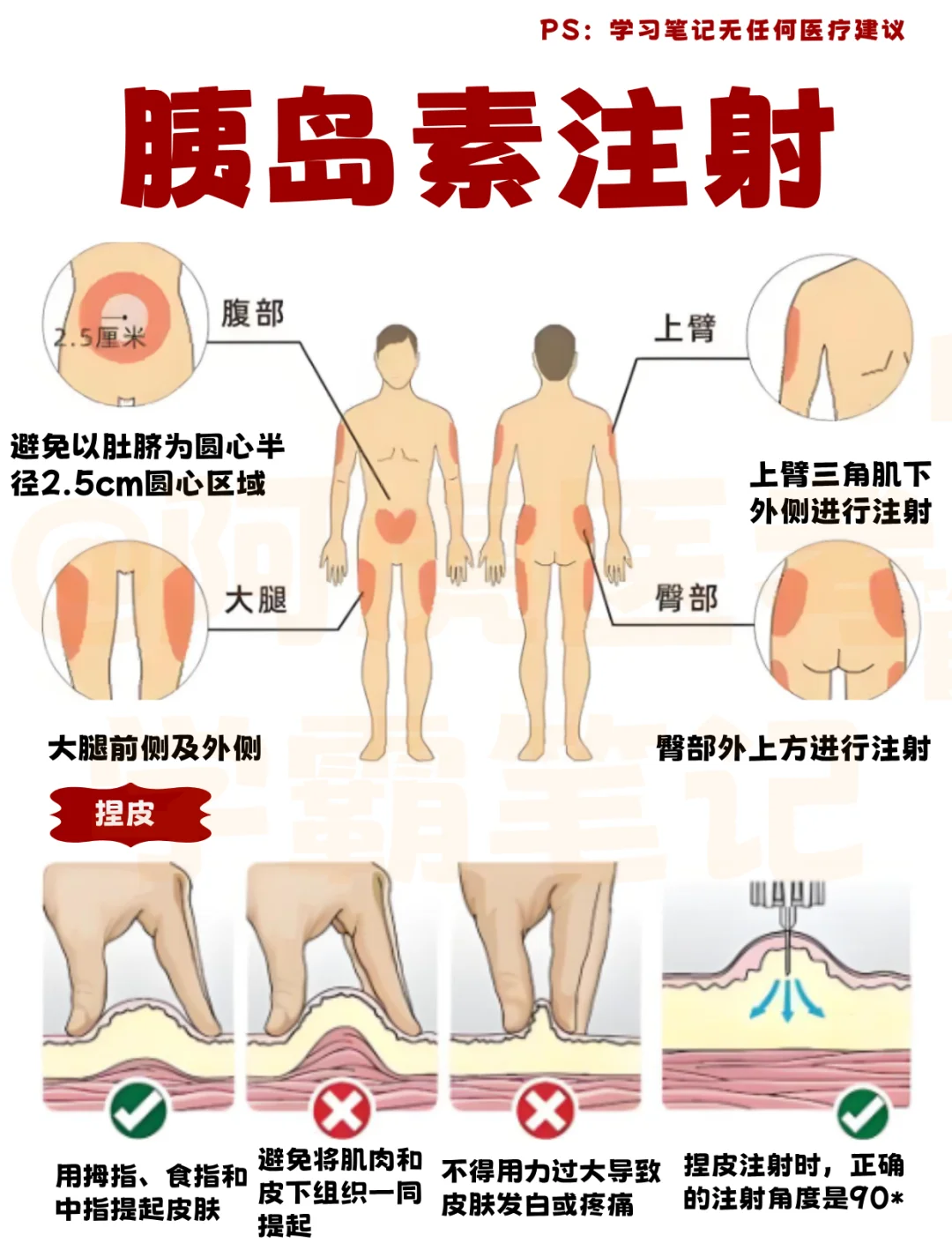 医学生笔记📒：胰岛素注射👆