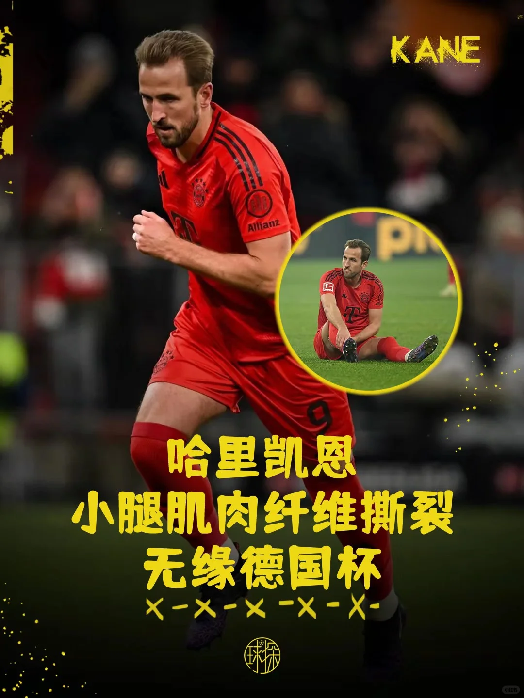 凯恩小腿肌肉纤维撕裂，无缘德国杯！
