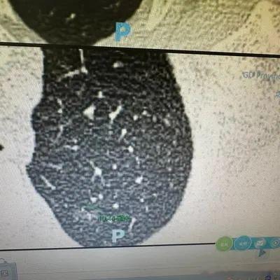 大家经常会问我一个问题，肺结节如果大于8mm或者大过1cm，是不是就说明很危险了