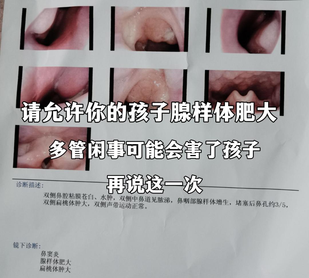 关于孩子腺样体肥大的理性思考.在这个信息爆炸的时代，作为一名医生，我深...