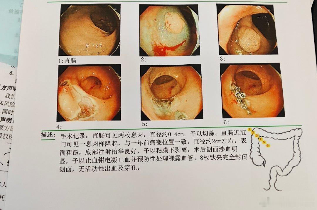 同一个部位，去年还是白白的一层，若隐若现，今年就长到很大一块了。 