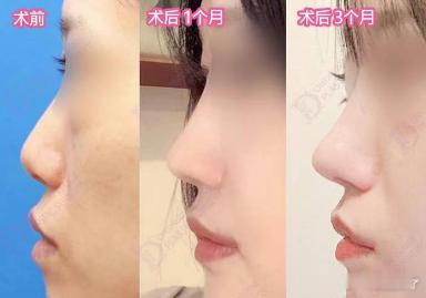 鼻尖有了支撑之后，整体线条会更顺，整体风格是偏秀气、精致那一挂，不是那种很夸张的
