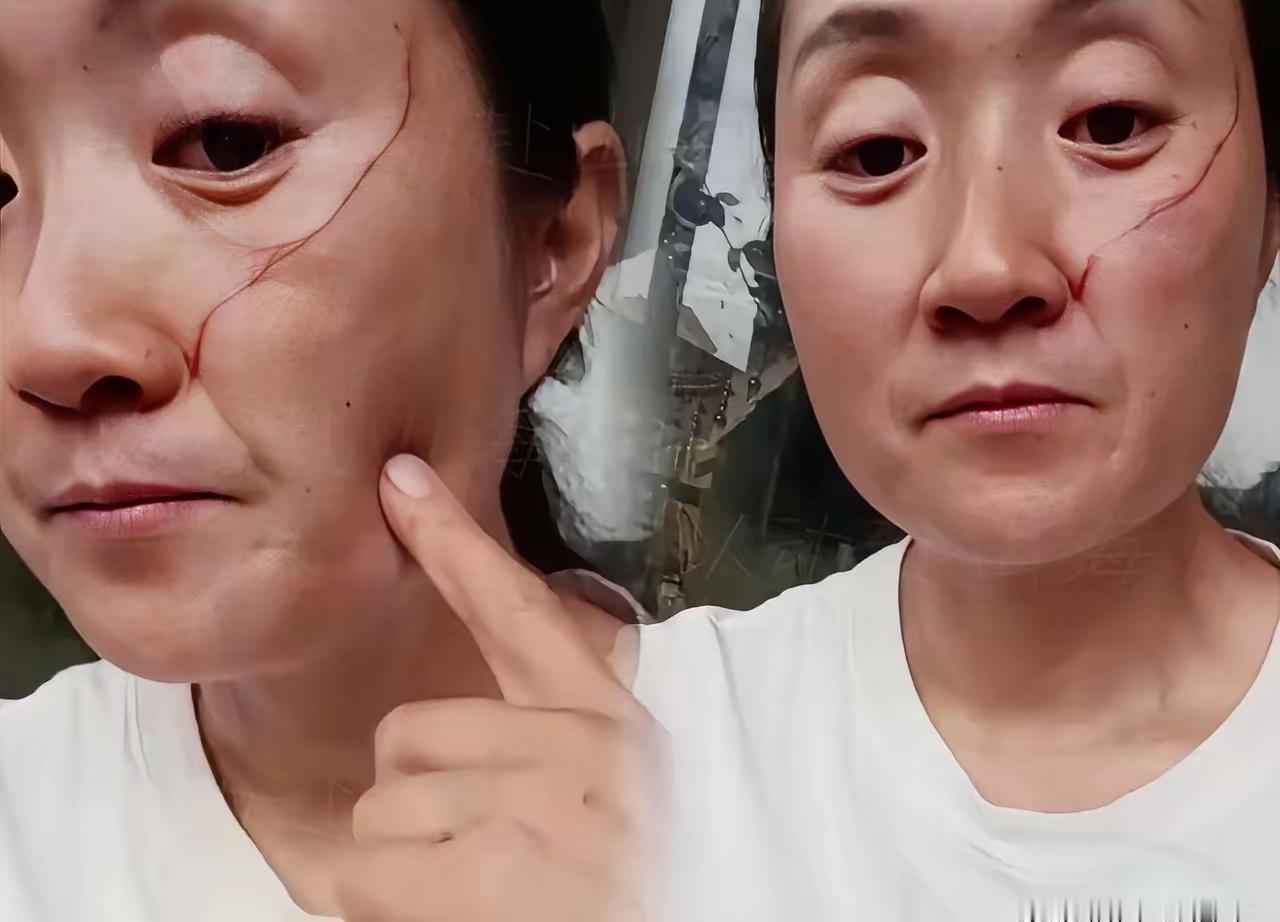 株洲这位全职陪读妈妈，脸上被女儿挠出一道血不淋子。高考刚结束，本该是全家松口气的