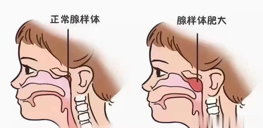 腺样体肥大，如果不想给孩子做手术，给出以下建议：①消积食 ，别吃撑，清积滞，运五