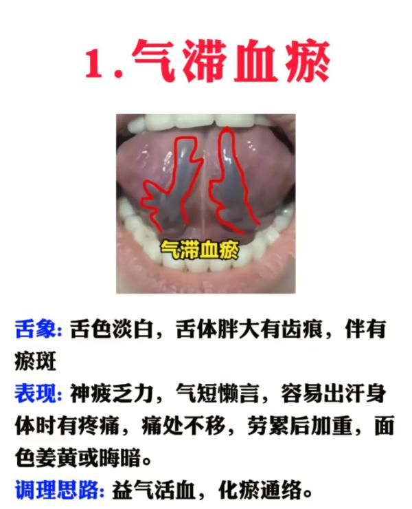 舌头出现这些信号，可能是体内血瘀在提醒你