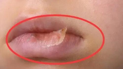 家长求助：孩子嘴巴干燥起皮，使劲喝水也不管用，这是怎么回事？

孩子正常嘴唇应该