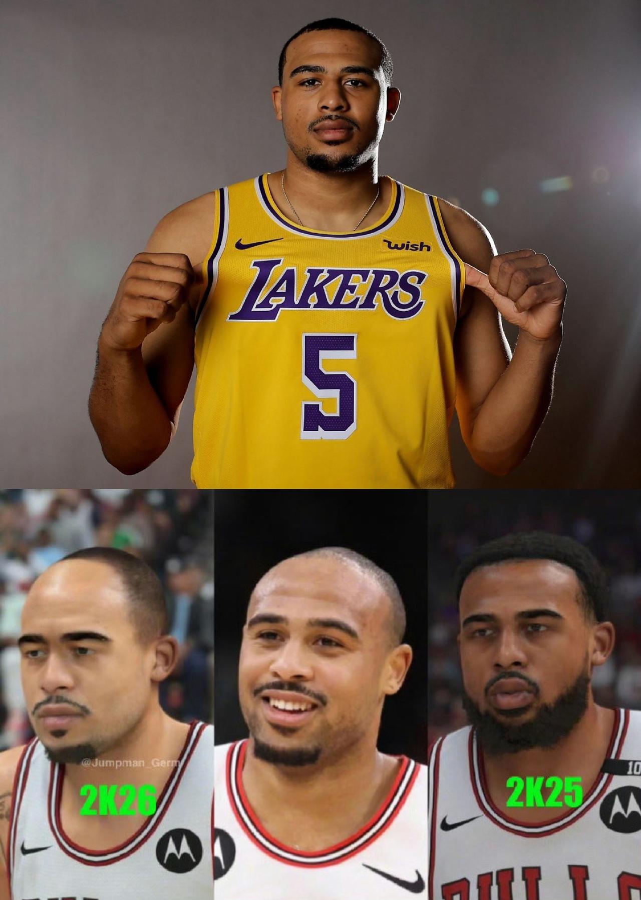 24岁的小伙子发际线后移严重啊