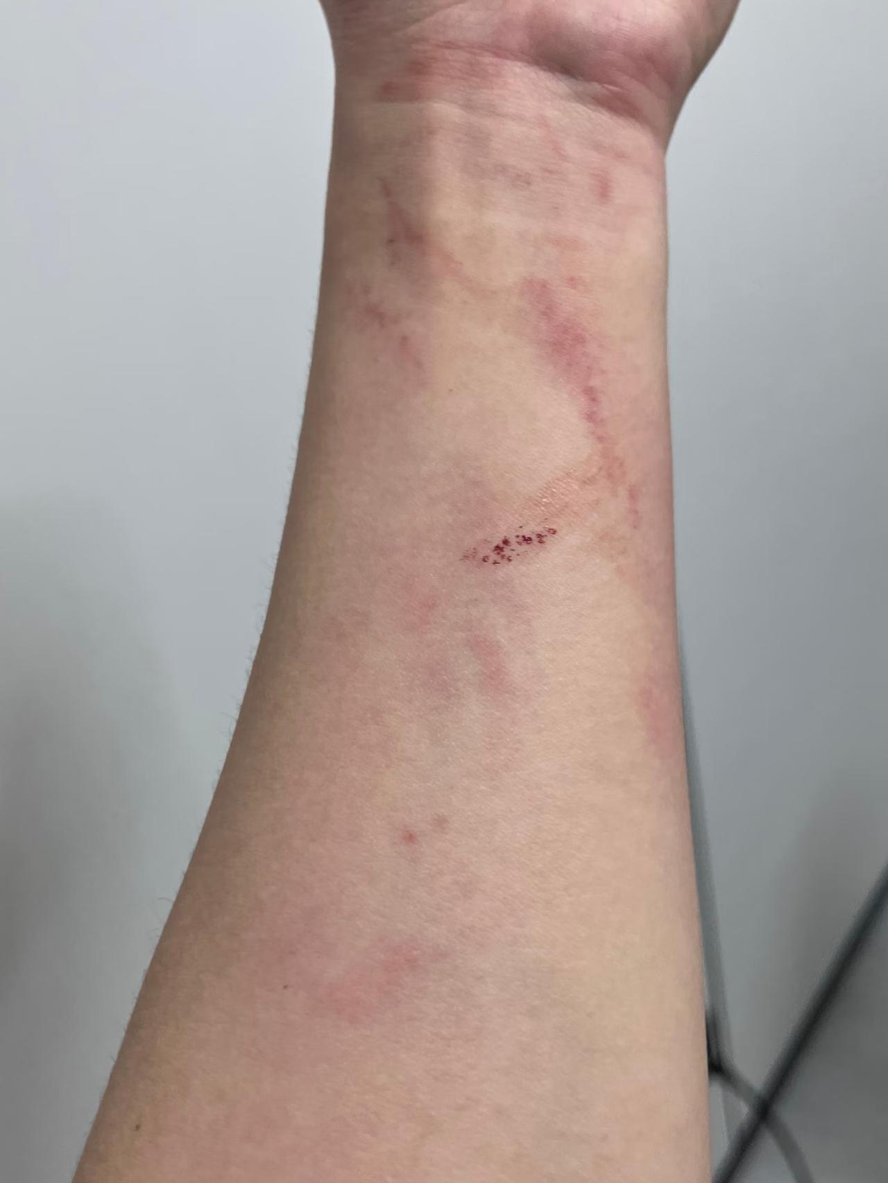 我同事被亲哥打了

她自己刚毕业，本来还打算找个稳定工作就搬出去租房，就是不想跟