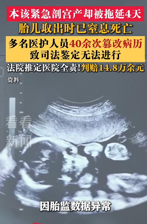 成都，孕妇产检胎监不正常，住进了医院。本该及时剖腹产，结果硬生生拖了 4 天，导