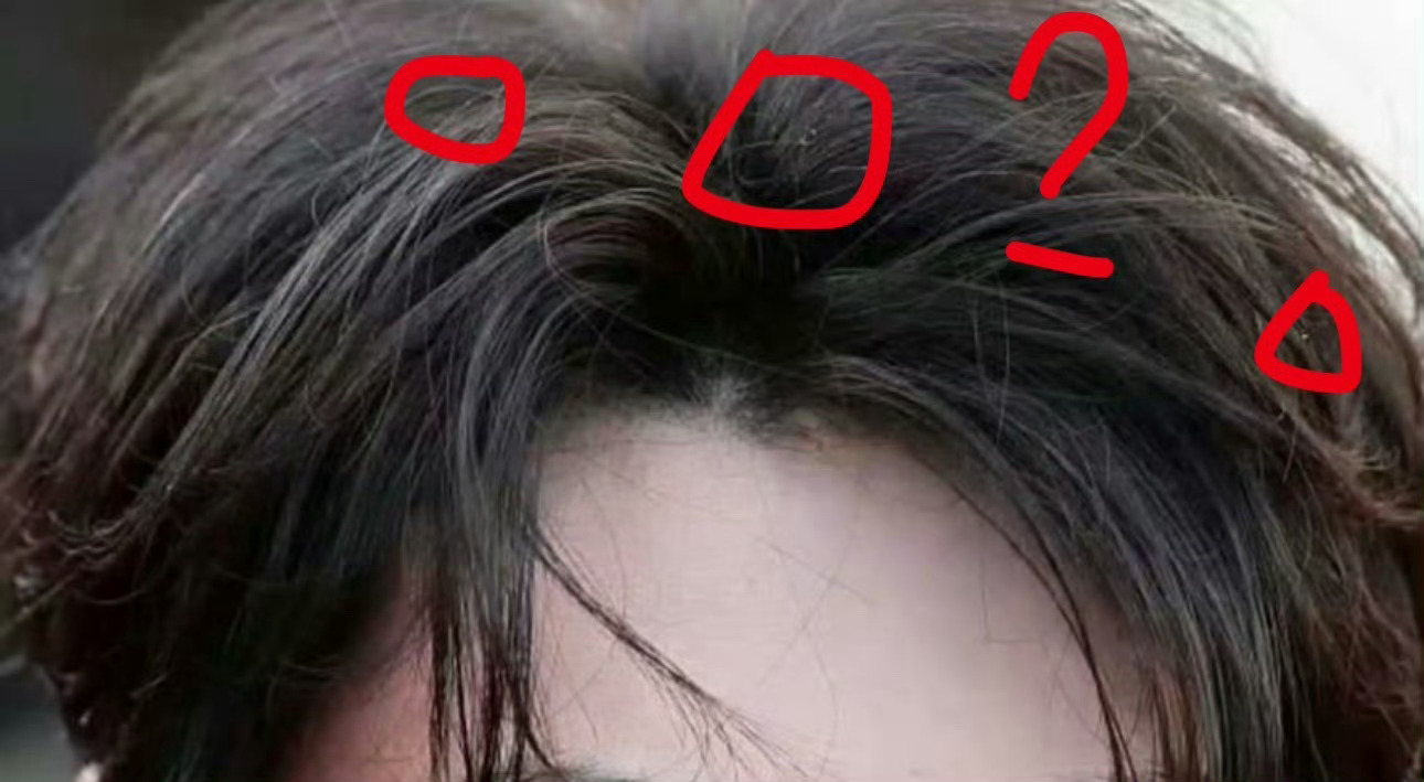 有网友疑问，图中画圈的是田栩宁大帅比的头皮削吗？