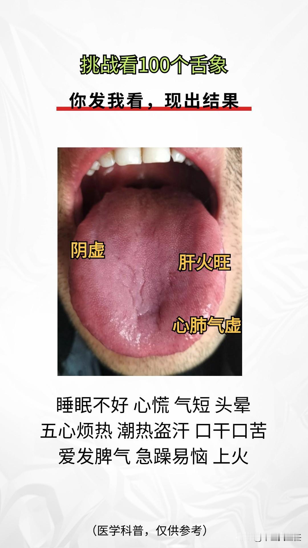 今天不忙，继续公益舌诊中[惊喜]有问题直接发来，1分钟出结果

注意拍摄清晰，看