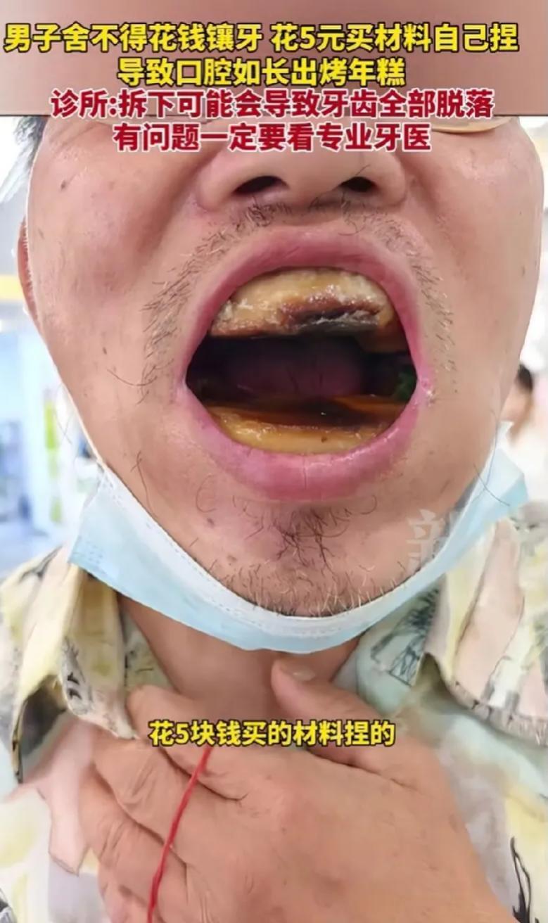 惊掉下巴！5块钱就想搞定镶牙大事，结果直接“翻车”成“牙雕怪”！这事儿说出来，保