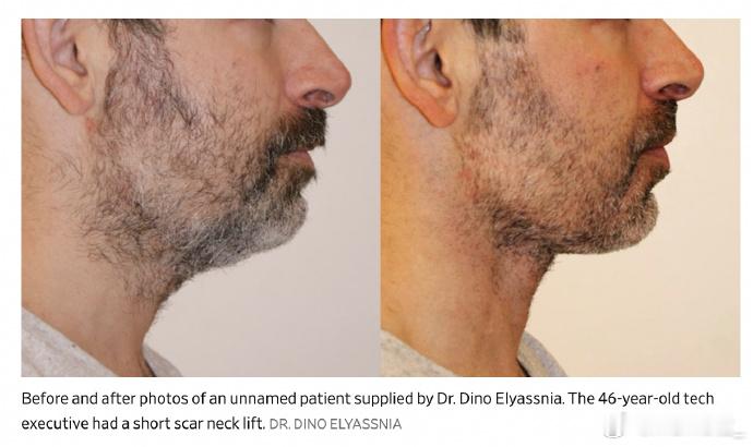 为了不被裁员硅谷科技男扎堆做医美 其实有资本的男的对自己形象管理特别严苛欧美圈那