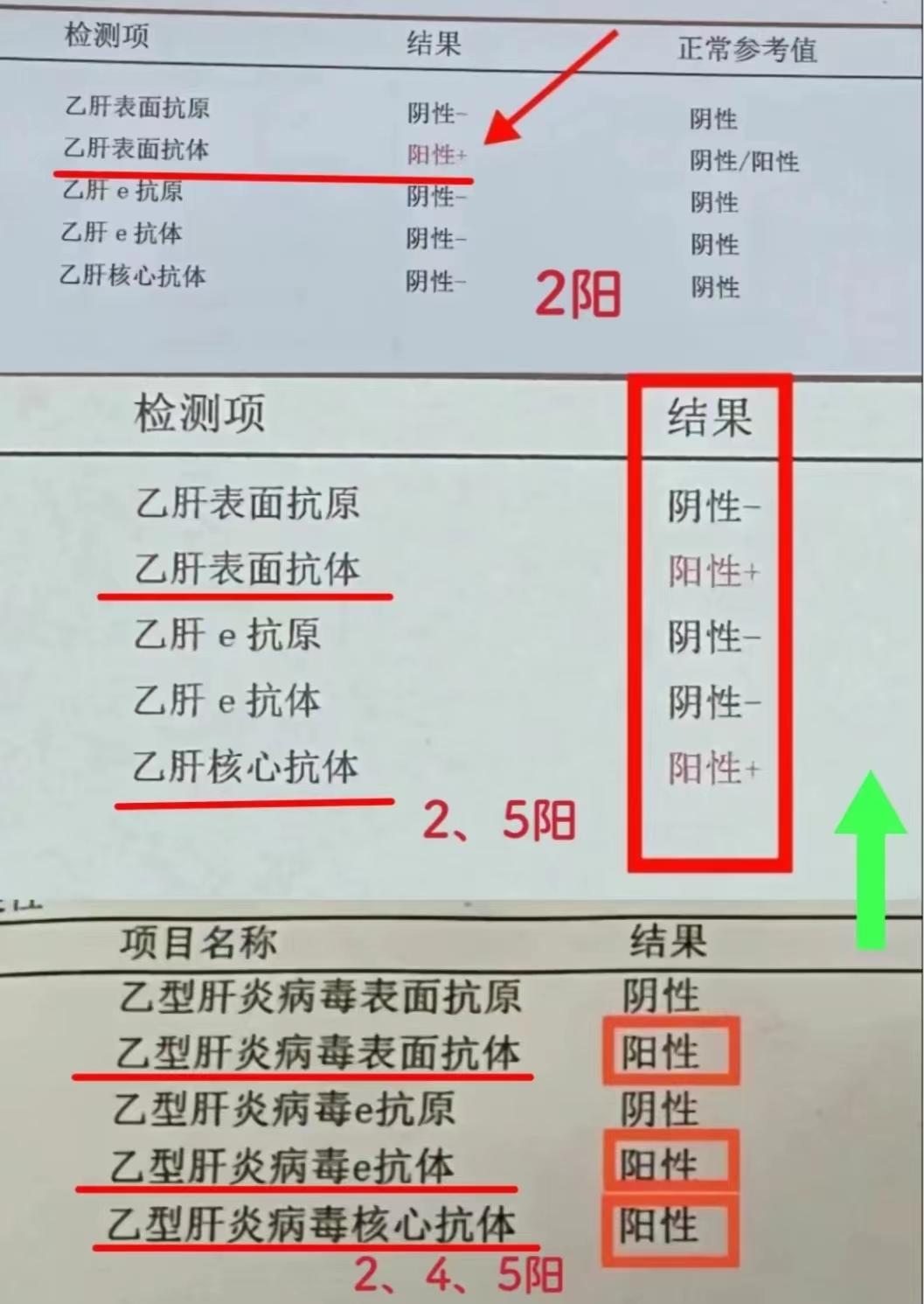 乙肝五项中这些指标阳性反而要恭喜你!。2阳：表面抗体阳性，说明乙肝有保护性抗体，不会感染乙肝，但如果5项全阴，一定要去注射乙肝疫苗，保证第2项阳性。
2、5阳：说明曾经感染过乙肝，但已经好了，出现保护性抗体，再次感染的几率很小。
2、4、5阳：同样说明曾经感染过乙肝，但已经基本实现临床治愈，不需要过度担心，但还是要定期复查。