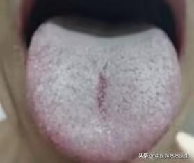 舌苔厚腻、痰湿重，用二陈汤不管用，不仅仅是脾虚！

舌苔厚腻，痰湿重，用了二陈汤