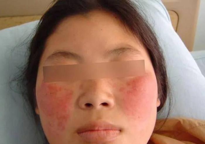 网上很多人关注红斑狼疮可能的病因和预防方法，我们来科普一下，
目前红斑狼疮的确切