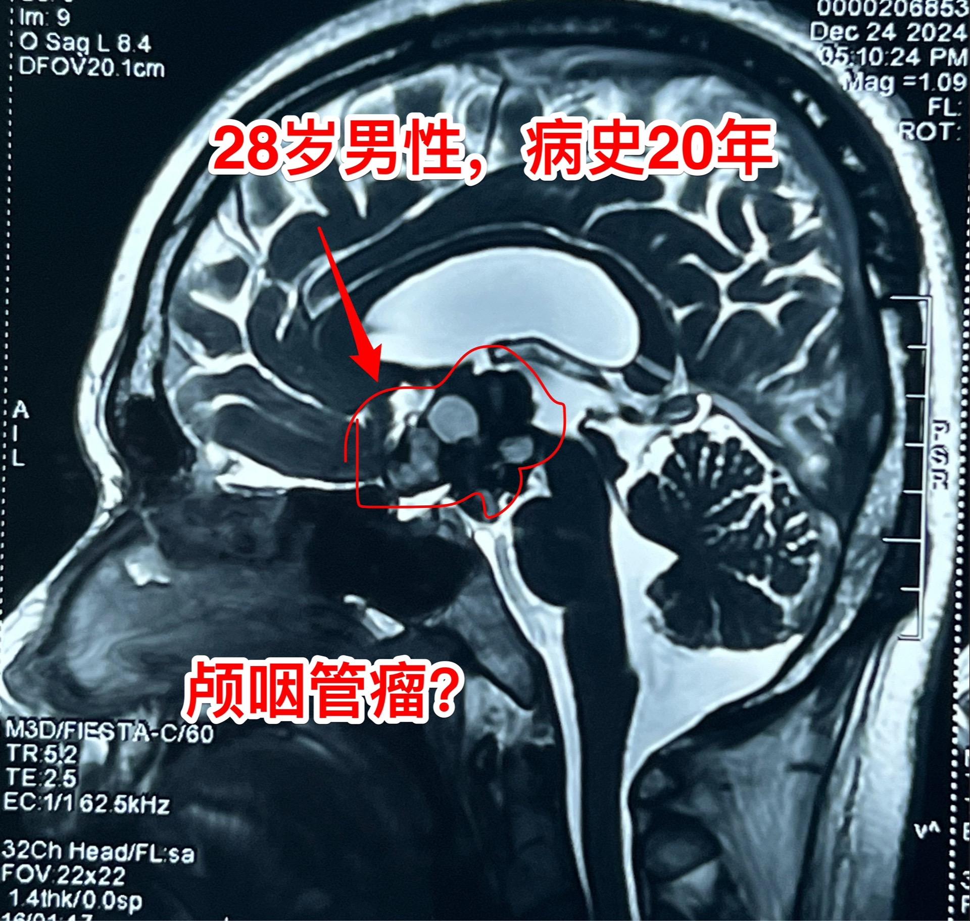 鞍区肿瘤长了20年，才下决心作手术！元旦之后的第一个鞍区肿瘤手术，怀疑...
