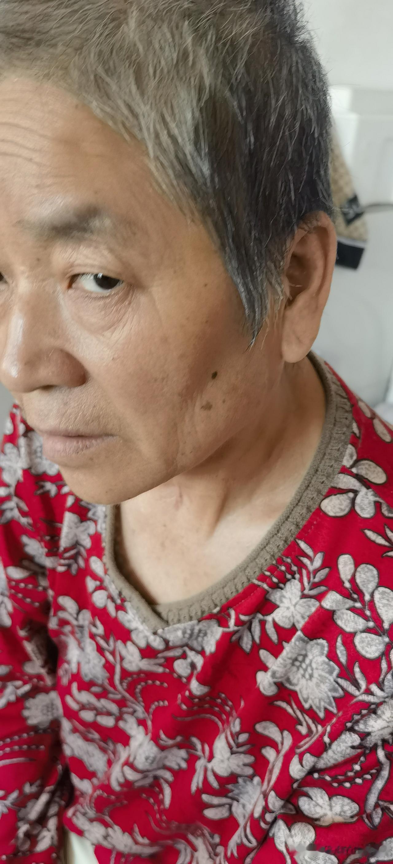 现在的状态：不能自理。人扶着能走几十米。自己能吃饭，大小变你问知道。你不问想不起