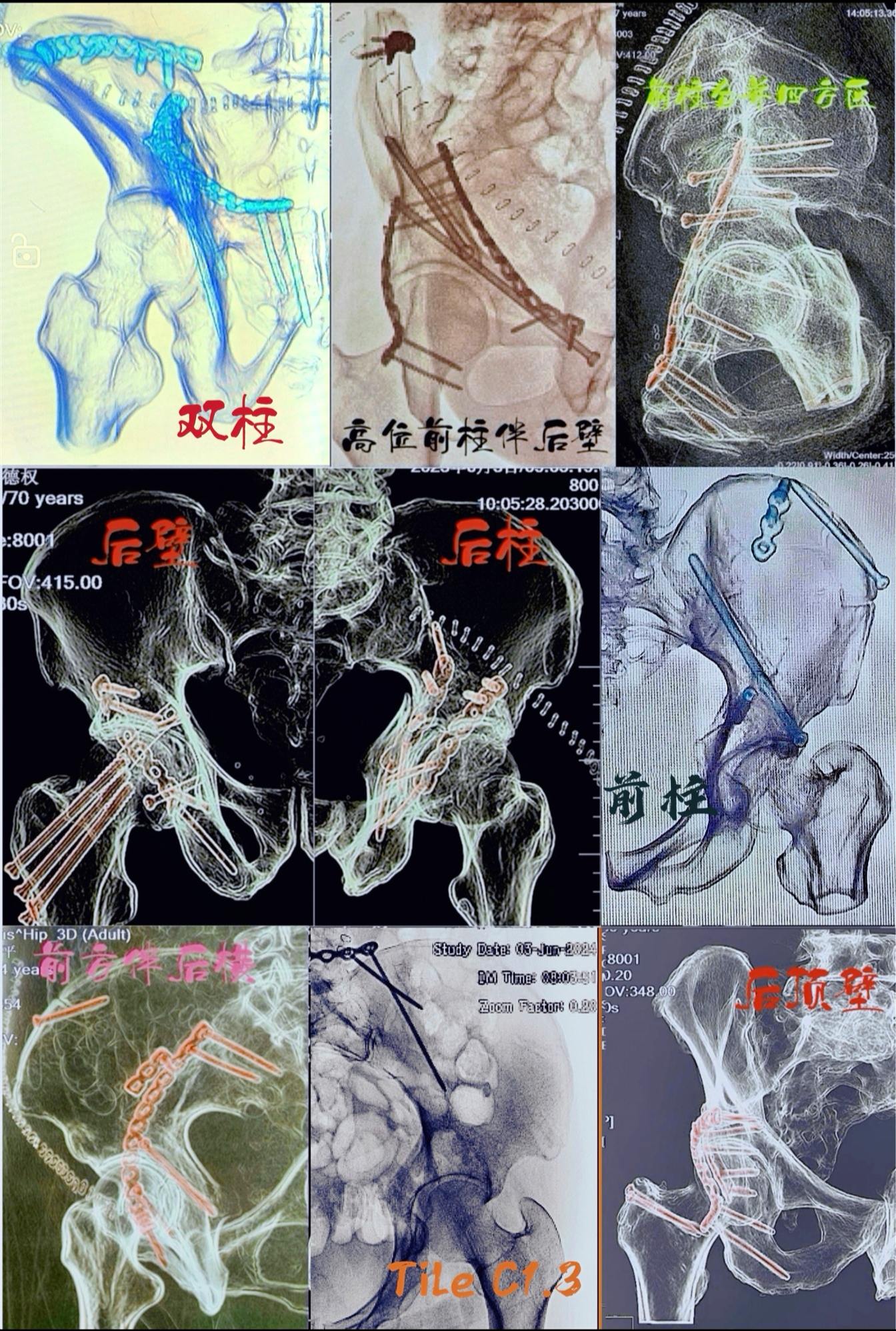 从医二十载，回头看看，其实能完成的工作也只有这么多！生活没有想象的波澜...