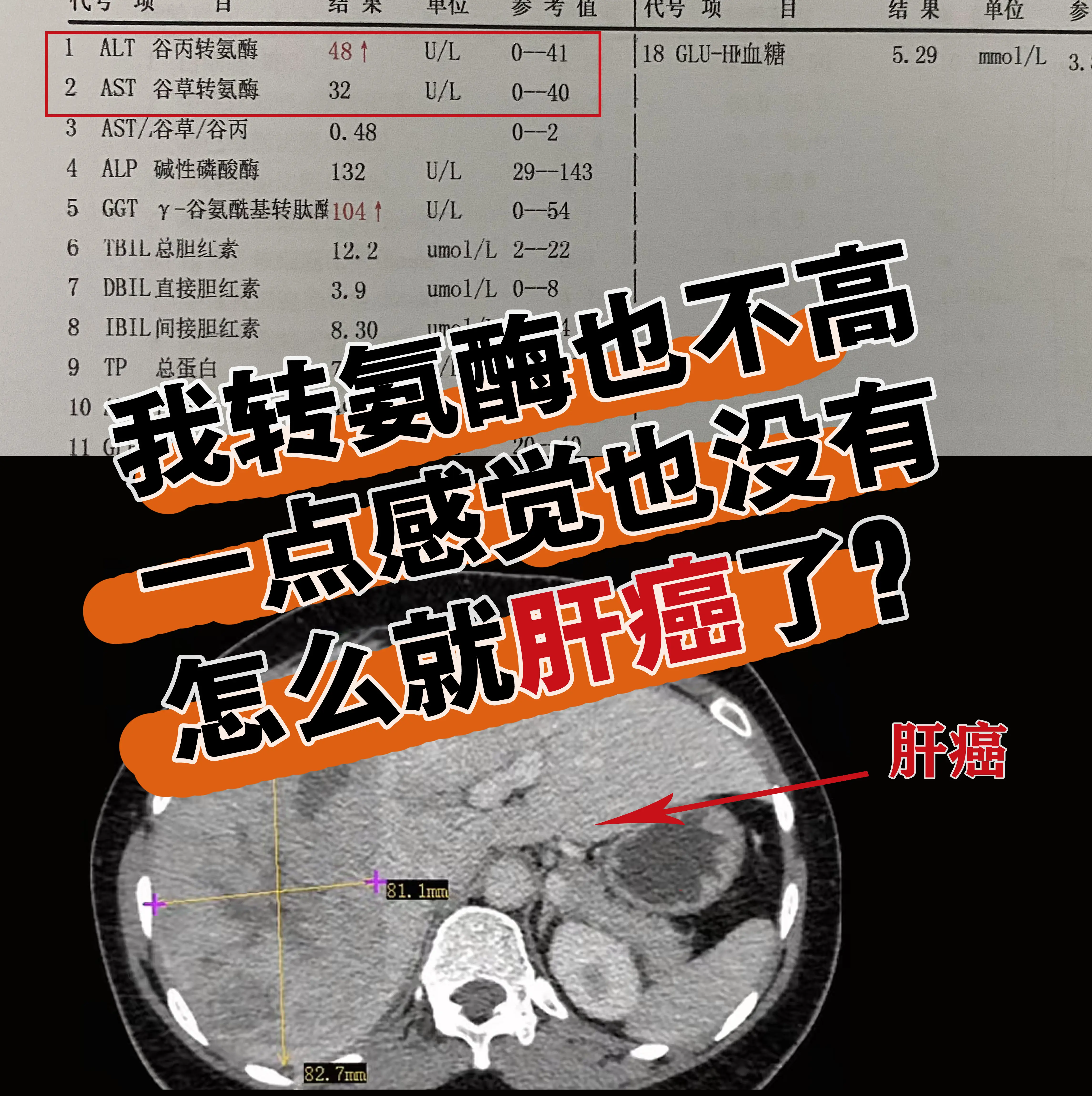 门诊上遇到一位临沂患者，有多年乙肝病史，平时不痛不痒，便没放在心上。前...