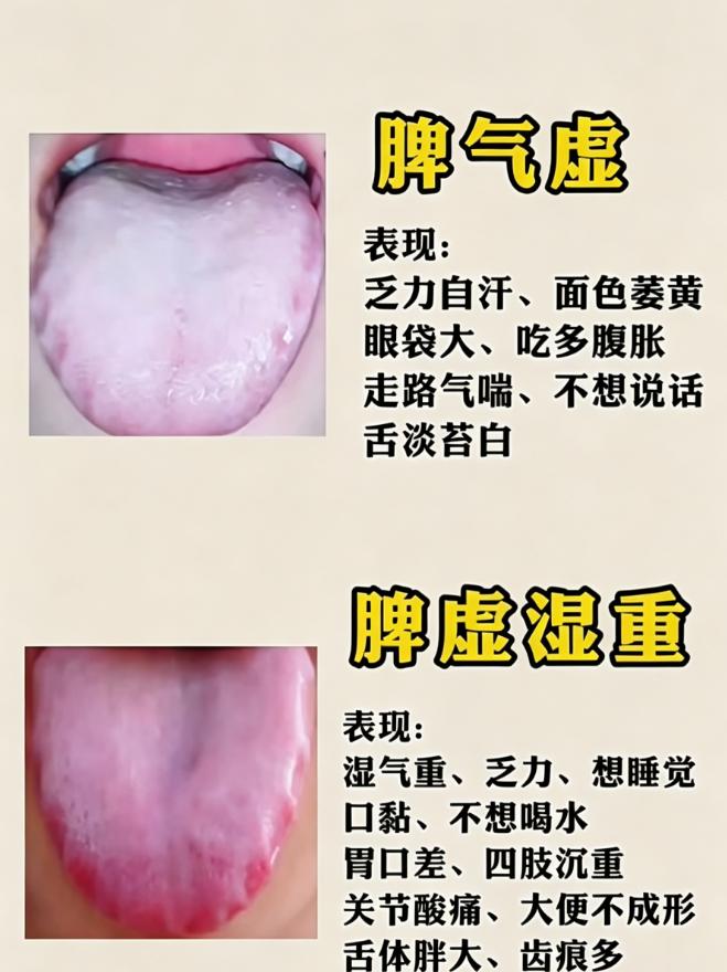 6 种脾虚舌象对照自查，看看你是哪一种