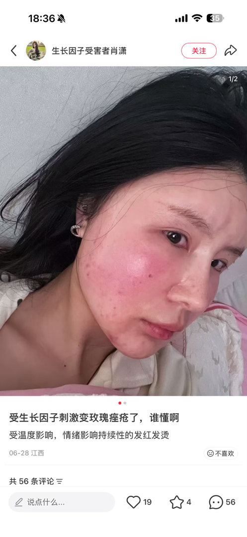 无意中刷到当年打生长因子的，真的好可怕，这种完全过度生长了吧，都是被庸医害了….