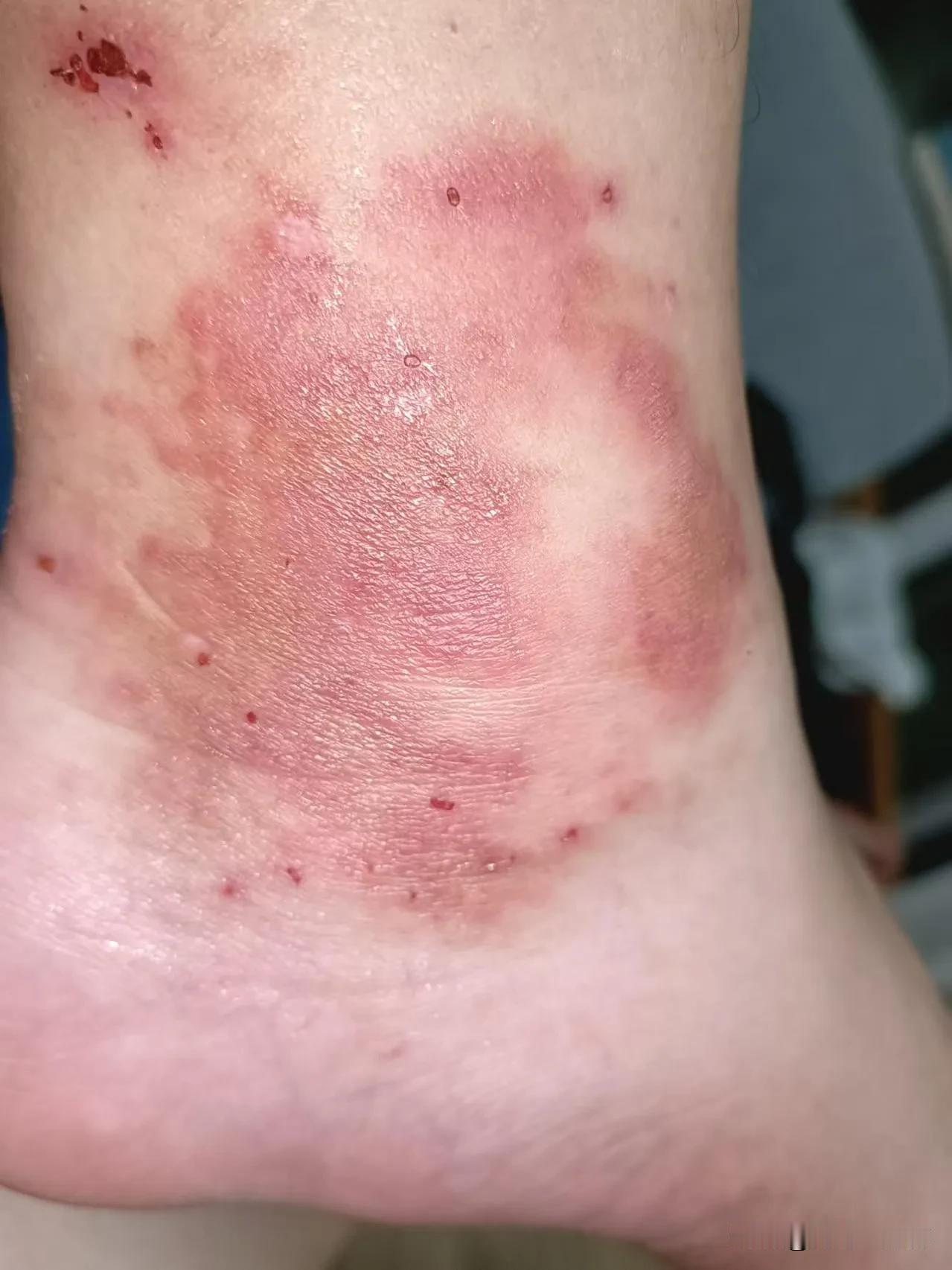 兄弟们！我中招了，就被蚊子叮了几口，转天脚脖子就这样了！这蚊子是变异蚊子啊[我想