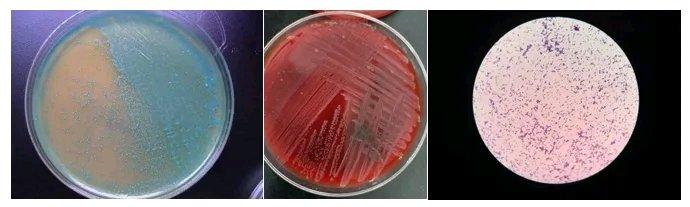深圳30岁孕妇小陈，产检一路绿灯，却突然高烧39℃，送医17小时后不幸流产。原来
