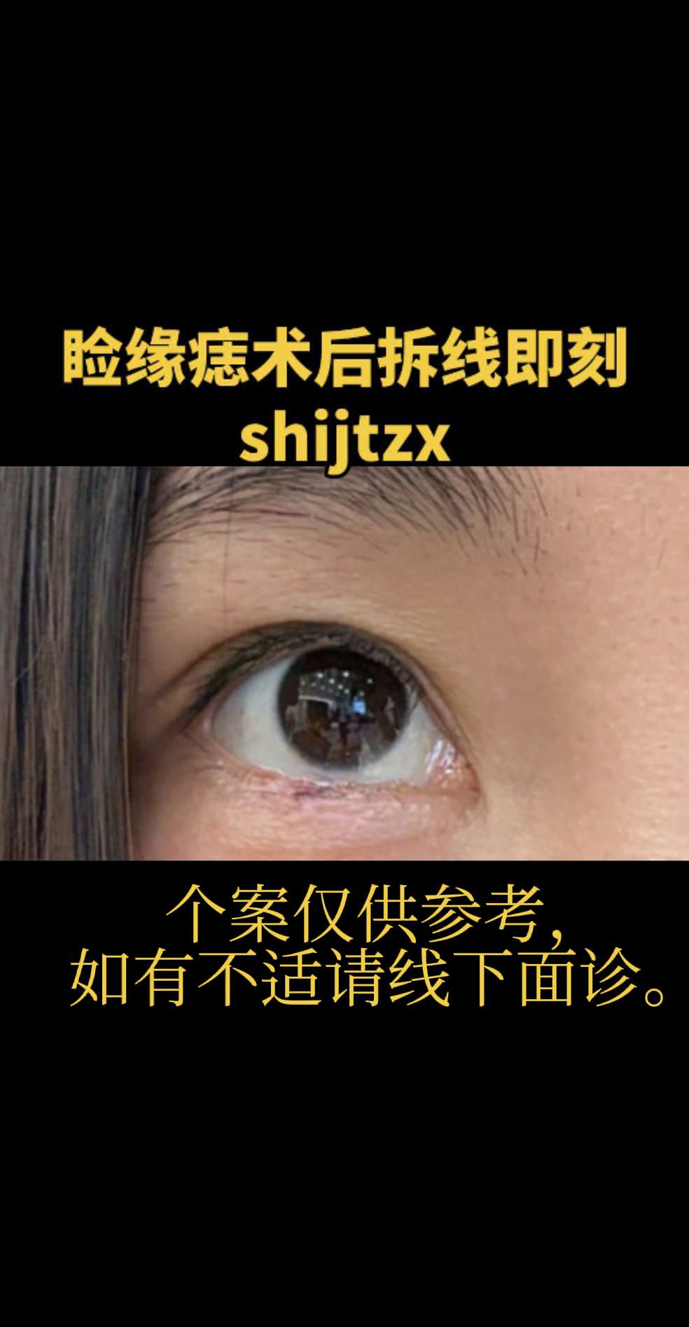 睑缘痣。下睑缘痣，整形美容技术切除，A-T瓣修复缺损，在当地拆线后反馈照片。